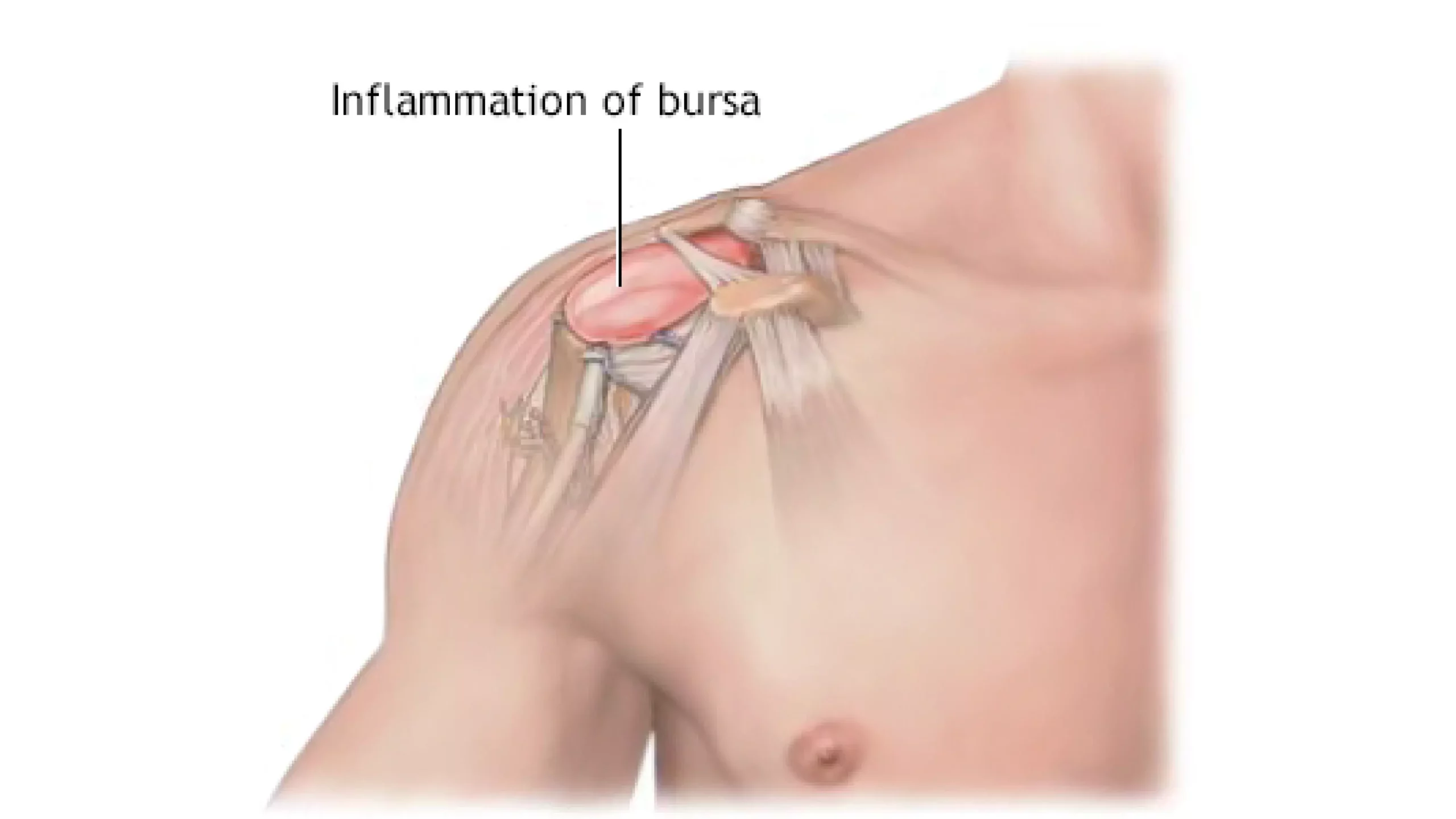 Inflammation of shoulder bursa