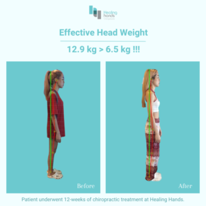 Healing Hands Chiropractic Singapore Before and After Comparison Picture