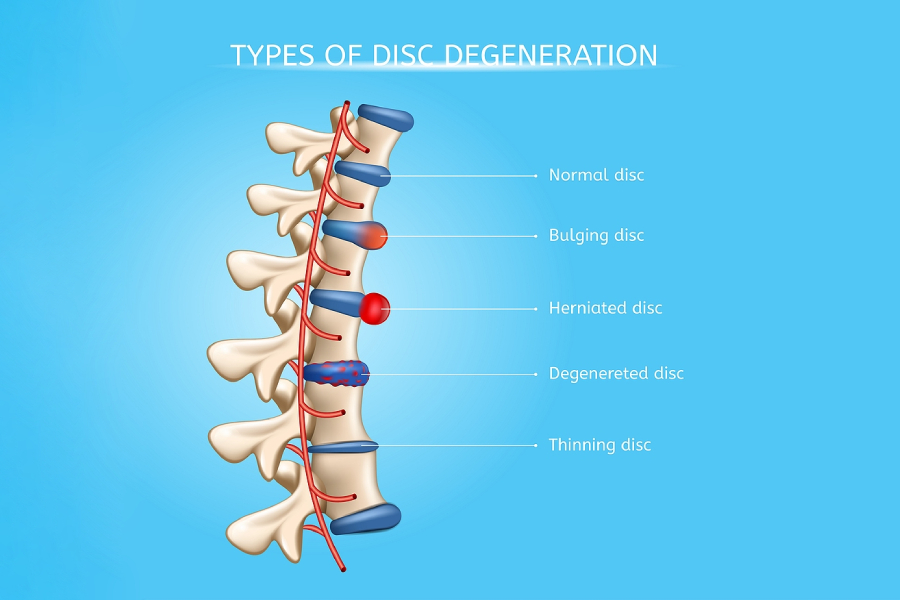 Is it a Herniated Disc, a Bulging Disc, or a Pinched Nerve? - Accent on  Health Chiropractic