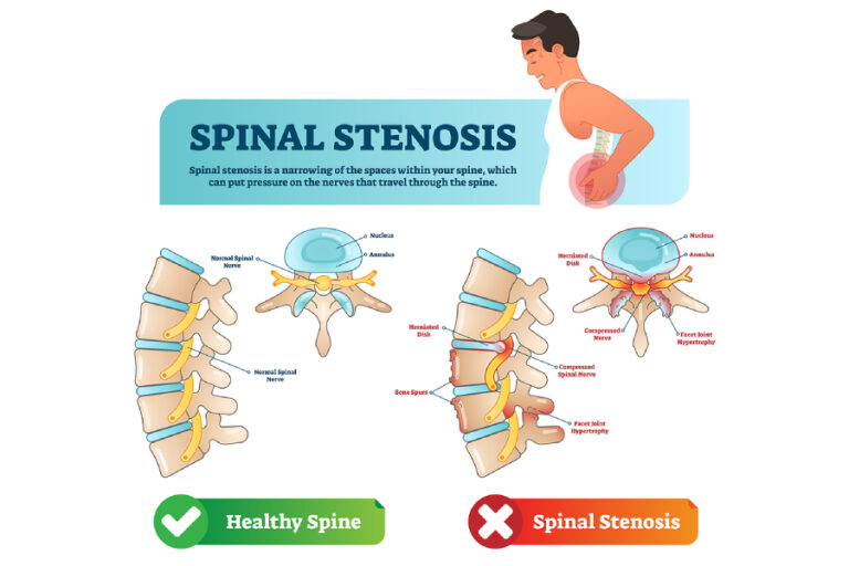 Can Chiropractic Care Help With Managing Spinal Stenosis?