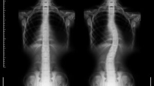 Chiropractic Care for Scoliosis in Adults vs Children - What’s Different