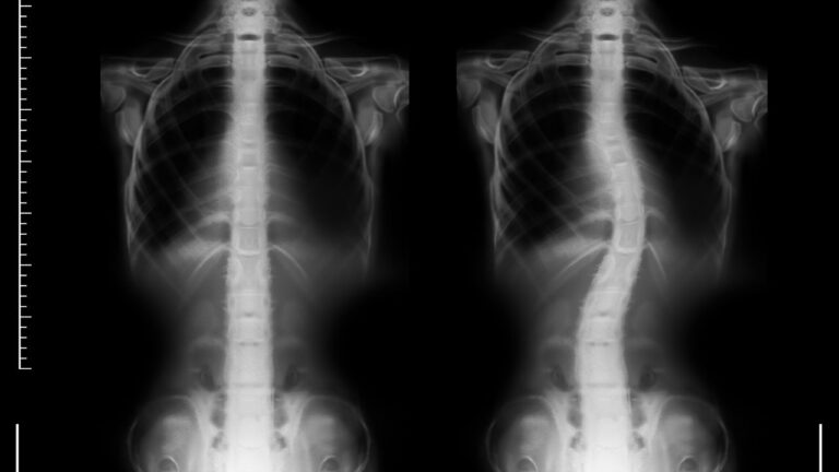 Chiropractic Care for Scoliosis in Adults vs Children - What’s Different