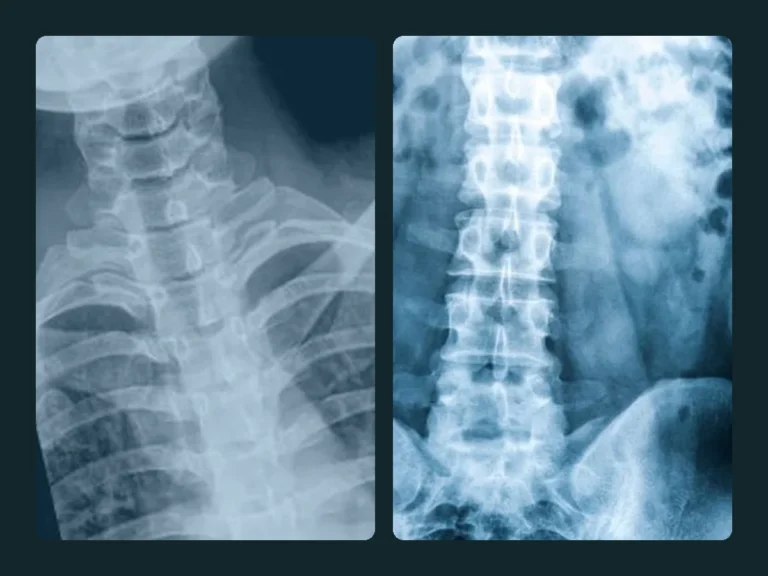 Two spine X-rays: the neck and upper back, and the lower back